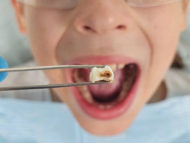 Best Emergency Dental Care for Abscessed Tooth in San Felipe, TX
